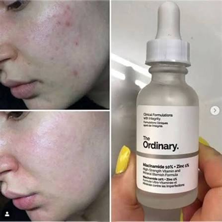 The Ordinary Niacinamide 10% + Zinc 1% Serum – Pores Minimize &amp; Oil Control